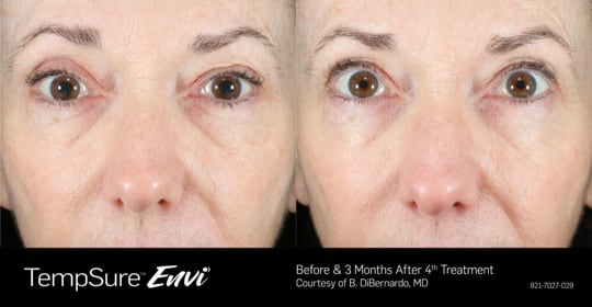 TempSure Envi - Before & 3 months after 4th Treatment