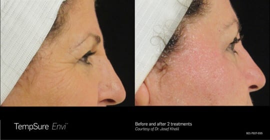 TempSure Envi - Before & after 2 treatments